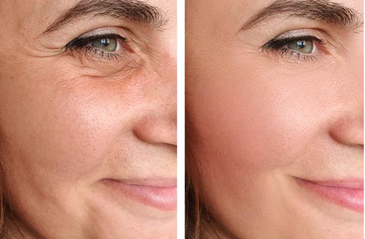 Resultados de lifting facial